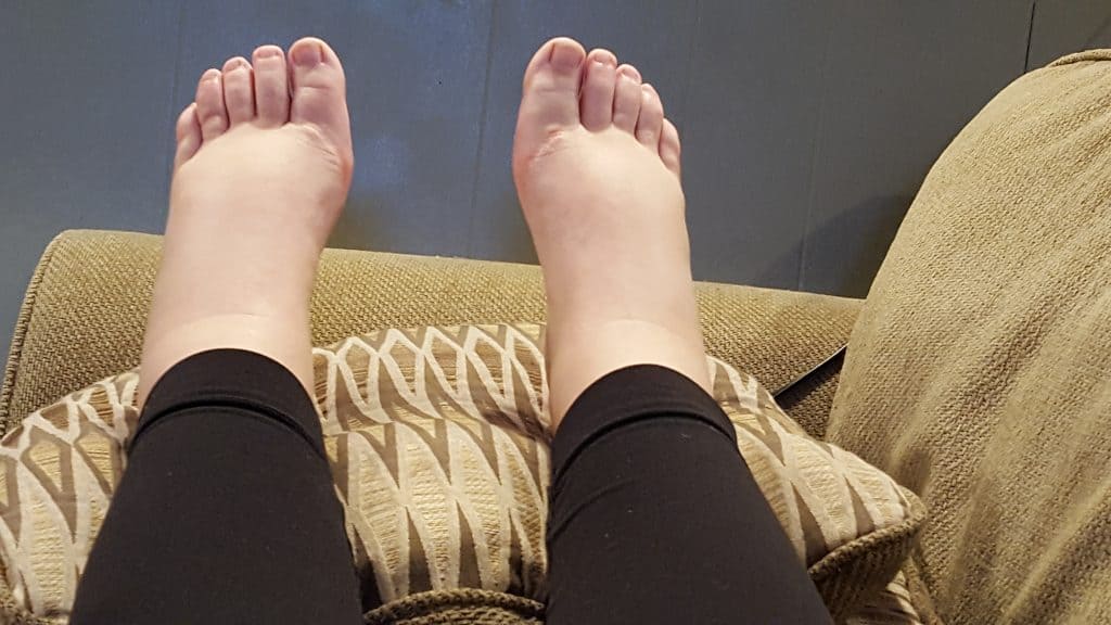 swollen feet propped up on a pillow